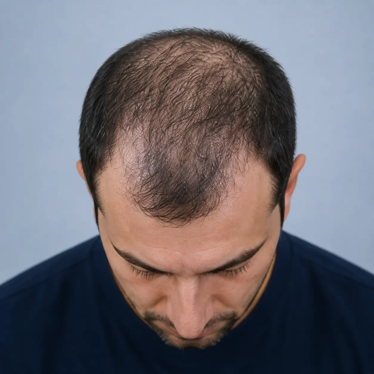 Hair density improvement